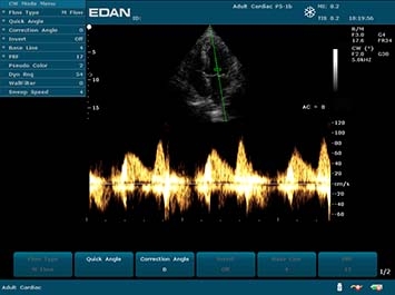 EDAN U2